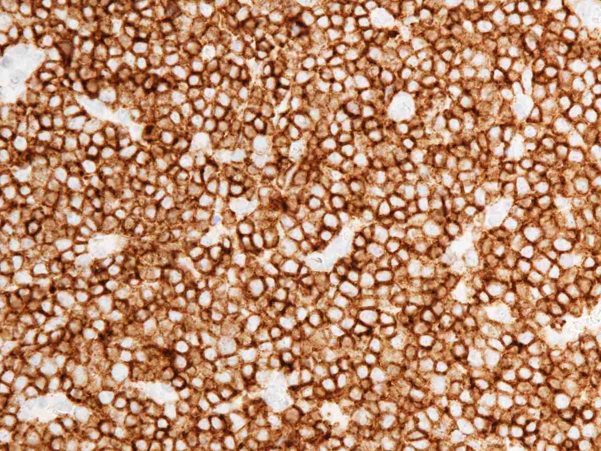 Lymph node 2010 CD1A 40X